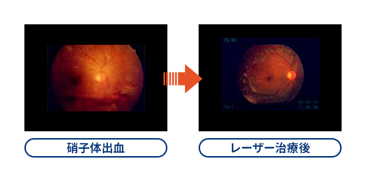 硝子体出血→レーザー治療後